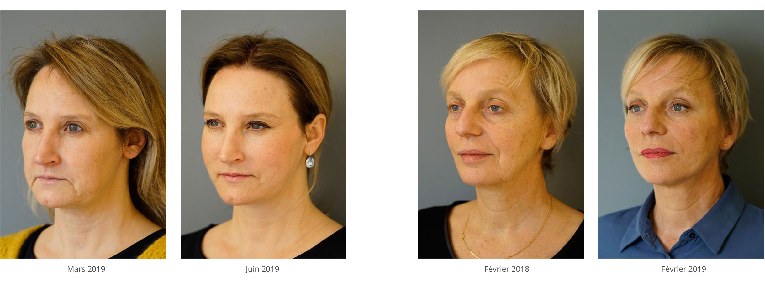 Resultat Easylift 2019 Lifting du visage sans chirurgie avec fils cranté sur le visage de femme de 51 ans et 55 ans
